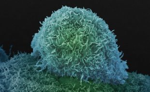 Black men have double the risk of dying of prostate cancer