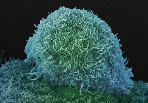 Black men have double the risk of dying of prostate cancer