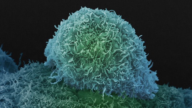 Black men have double the risk of dying of prostate cancer